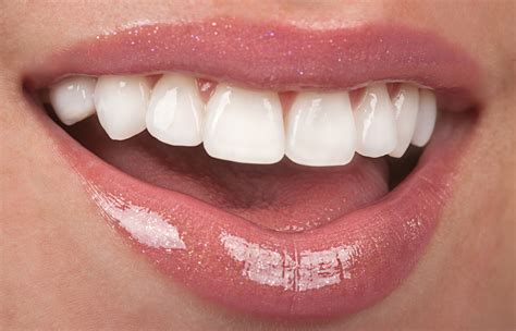 Magic Teeth Braces: What You Need to Know